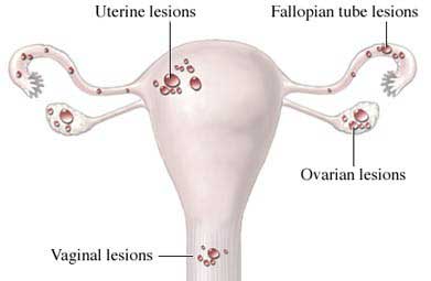 endometriosis can include uterine lesions, fallopian tube lesions, ovarian lesions, and vaginal lesions