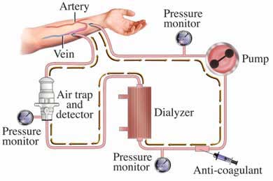 the dialysis process: patient's artery to pressure monitor to pump to anti-coagulent to pressure monitor to dialyzer to pressure monitor to air trap and detector back to the patient's vein