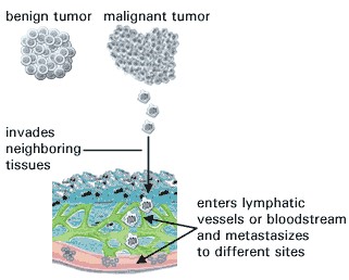 benign tumor vs malignant