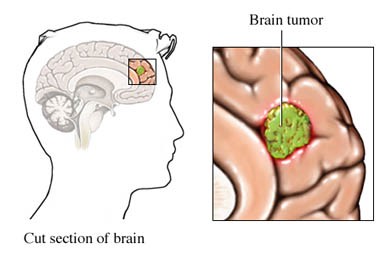 Man's unusual brain tumour symptoms cause B-cup boobs which